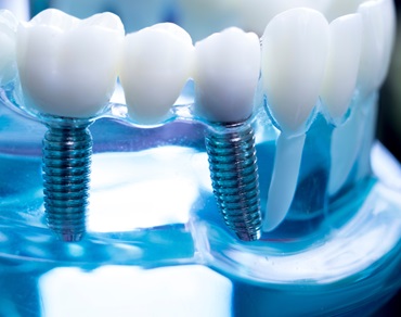 Dentist dental teeth teaching model showing titanium metal tooth implant screw.